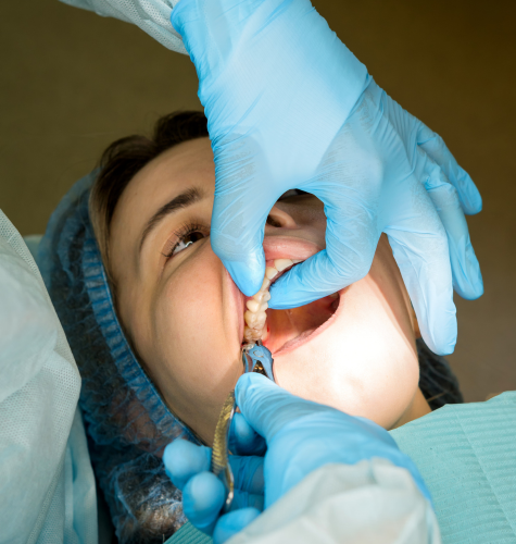 Wisdom Teeth Removal